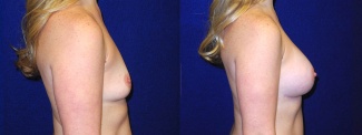 Right Profile View - Breast Augmentation - Silicone Implants