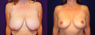 Frontal View - Breast Lift