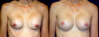 Frontal View - Breast Implant Revision - Silicone Implants