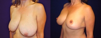 Left 3/4 View - Breast Lift