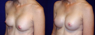 Left 3/4 View - Breast Implant Revision - Silicone Implants