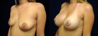 Left 3/4 View - Breast Augmentation with Periareolar Lift - Silicone Implants