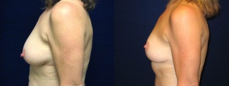 Left Profile View - Breast Lift After Pregnancy