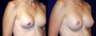 Right 3/4 View - Breast Implant Revision - Silicone Implants