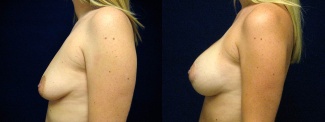 Left Profile View - Breast Augmentation with Periareolar Lift - Silicone Implants