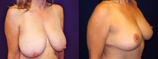 Right 3/4 View - Breast Lift