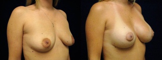 Right 3/4 View - Breast Augmentation with Periareolar Lift - Silicone Implants