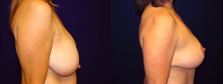 Right Profile View - Breast Lift