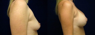 Right Profile View - Breast Augmentation with Periareolar Lift - Silicone Implants