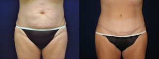 Frontal View - Tummy Tuck After Pregnancy