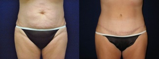 Frontal View - Tummy Tuck After Pregnancy