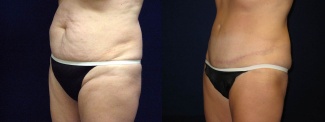 Left 3/4 View - Tummy Tuck After Pregnancy