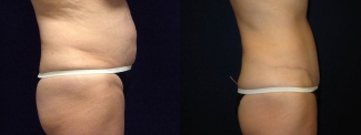 Right Profile View - Tummy Tuck After Pregnancy