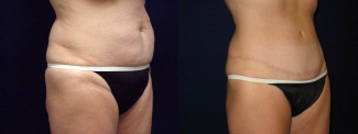 Right 3/4 View - Tummy Tuck After Pregnancy