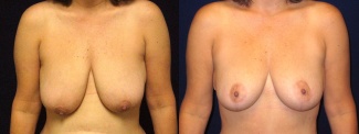 Frontal View - Breast Lift After Pregnancy