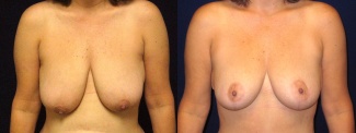 Frontal View - Breast Lift After Pregnancy