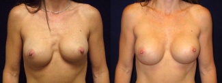 Frontal View - Breast Implant Revision - Silicone Implants