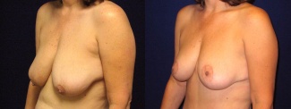 Left 3/4 View - Breast Lift After Weight Loss