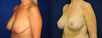 Left 3/4 View - Breast Augmentation with Lift - Silicone Implants