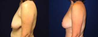 Left Profile View - Breast Lift After Pregnancy