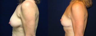 Left Profile View - Breast Lift After Pregnancy