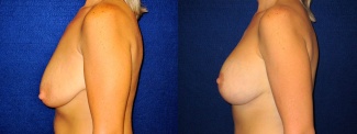 Left Profile View - Breast Augmentation with Lift - Silicone Implants