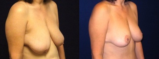 Right 3/4 View - Breast Lift After Pregnancy