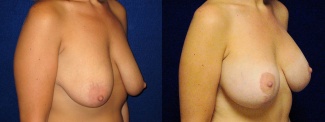 Right 3/4 View - Breast Augmentation with Lift - Silicone Implants