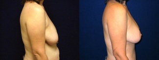 Right Profile View - Breast Lift After Pregnancy