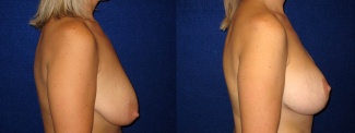 Right Profile View - Breast Augmentation with Lift - Silicone Implants