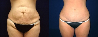 Frontal View - Tummy Tuck After Pregnancy