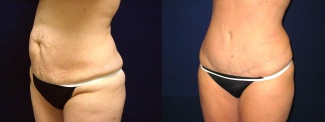 Left 3/4 View - Tummy Tuck After Pregnancy