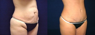 Right 3/4 View - Tummy Tuck After Pregnancy