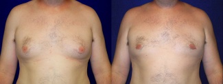 Frontal View - Male Breast Reduction