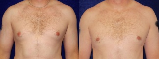 Frontal View - Male Breast Reduction