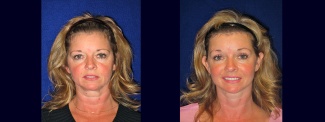 Frontal View - Facelift with Upper and Lower Eyelid Surgery and Browlift