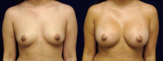 Frontal View - Breast Augmentation - Silicone Implants
