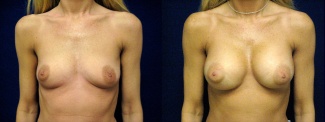 Frontal View - Breast Augmentation