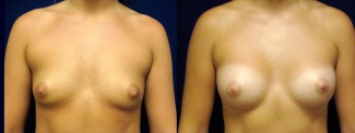 Frontal View - Breast Augmentation - Silicone Implants