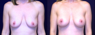 Frontal View - Breast Augmentation - Silicone Implants