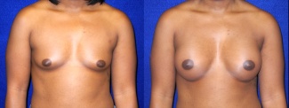 Frontal View - Breast Augmentation