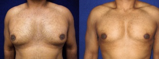 Frontal View - Male Breast Reduction