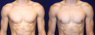 Frontal View - Male Breast Reduction