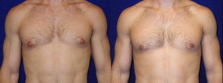 Frontal View - Male Breast Reduction