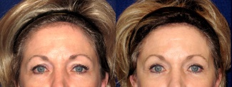 Fontal View - Upper Eyelid Surgery
