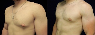 Left 3/4 View - Male Breast Reduction