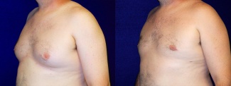 Left 3/4 View - Male Breast Reduction