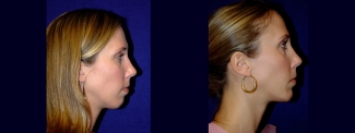 Right Profile View - Chin Implant