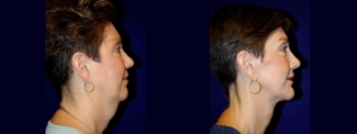 Right Profile View - Facelift & Chin Implant