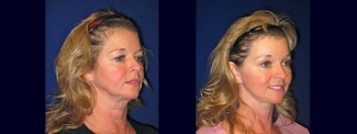 Right 3/4 View - Facelift with Upper and Lower Eyelid Surgery and Browlift